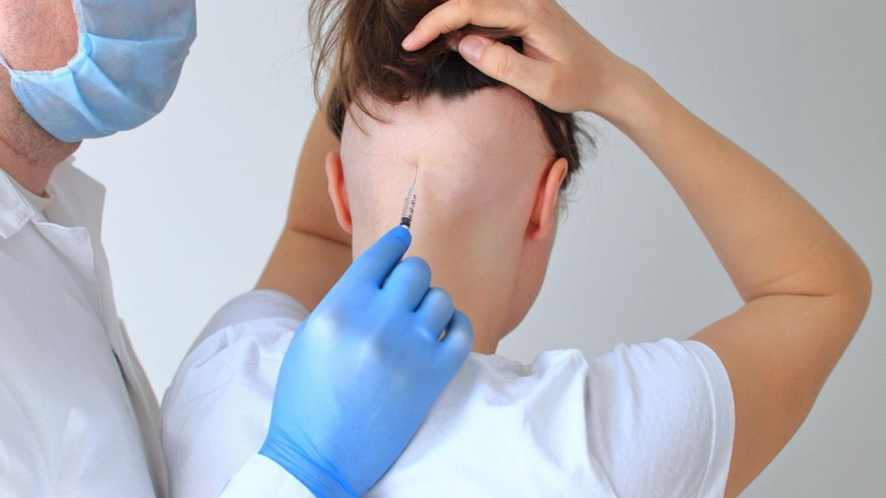 Alopecija
