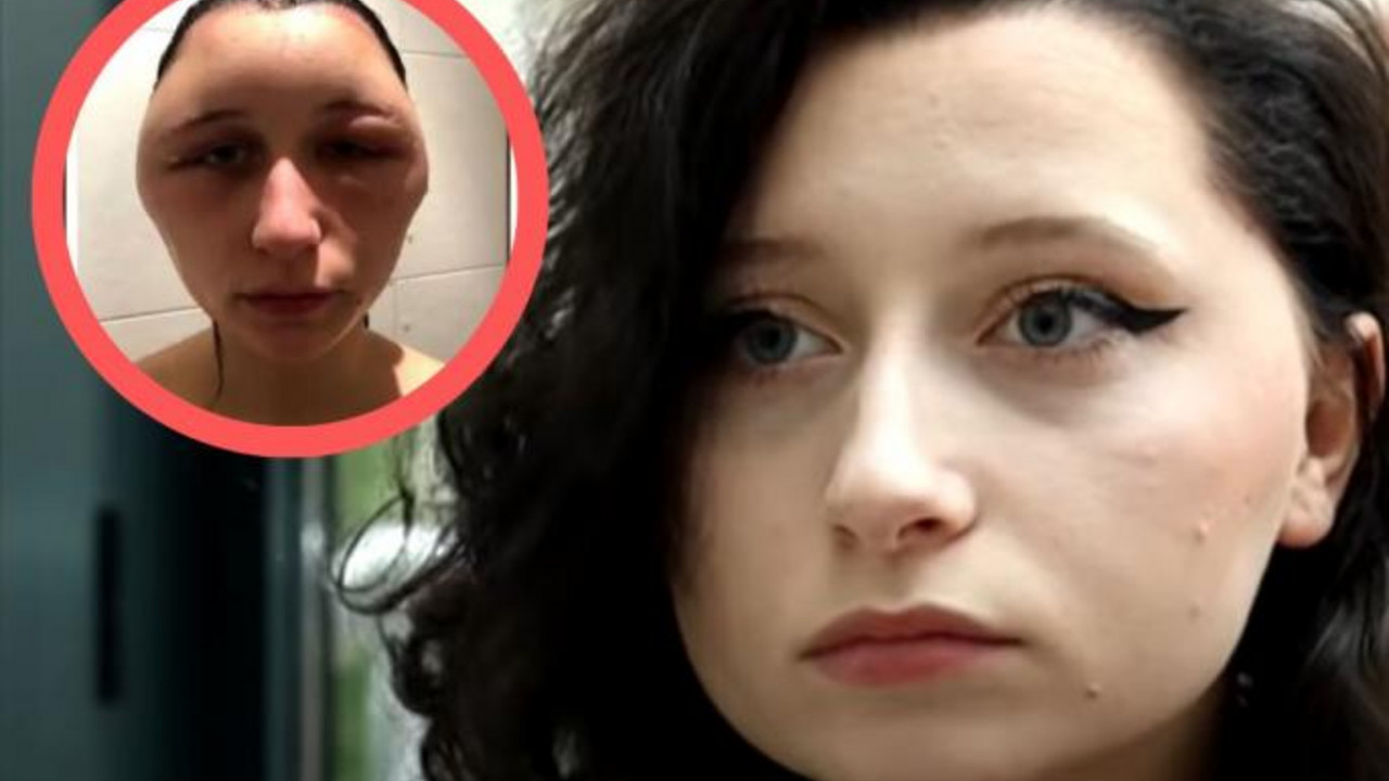 alergija